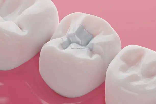 fillings2